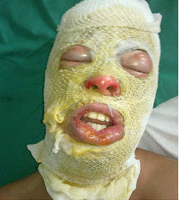 jack-kirk-rosto-enfaixado