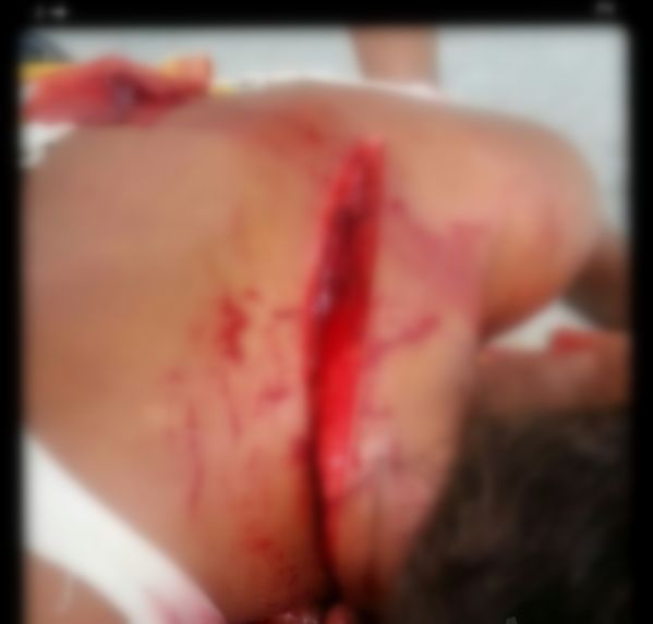 Por pouco homem não deixa mulher paraplégica após um golpe de facão