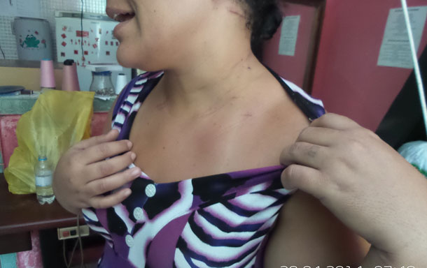 Mulher quase morre carbonizada após ser espancada pelo companheiro