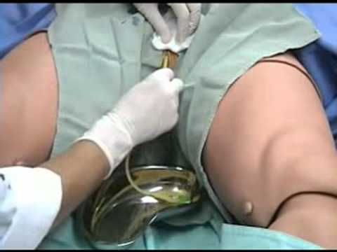 Autônoma consegue cirurgia para retirada de cateter no rim