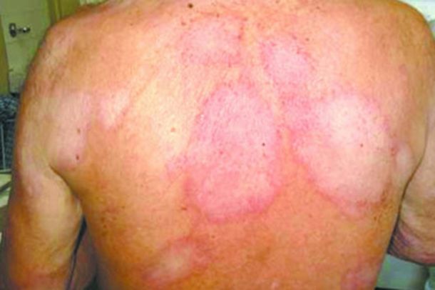 Número de novos casos da Hanseníase em Sergipe preocupa o Ministério da Saúde