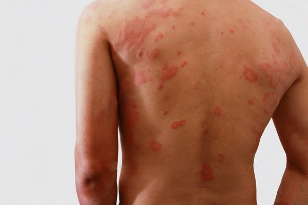 Saúde mobiliza municípios para diagnóstico precoce da hanseníase