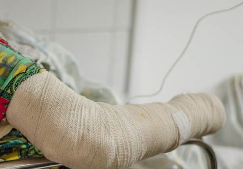 Cai em 84,8% o número de vítimas de queimaduras durante o São João