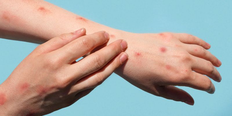 Sergipe registra três casos de varíola dos macacos