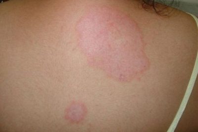 JANEIRO ROXO: Governo de Sergipe promove ações para orientar sobre a hanseníase