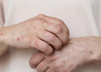 Janeiro Roxo: campanha destaca conscientização e combate à hanseníase